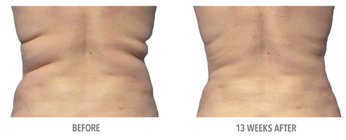 coolsculpting_home_before_after_pic