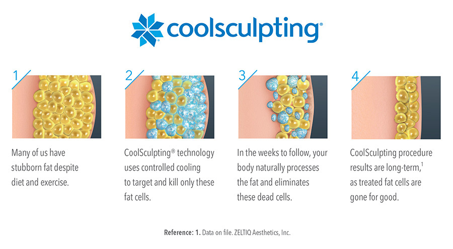 coolsculpting_process