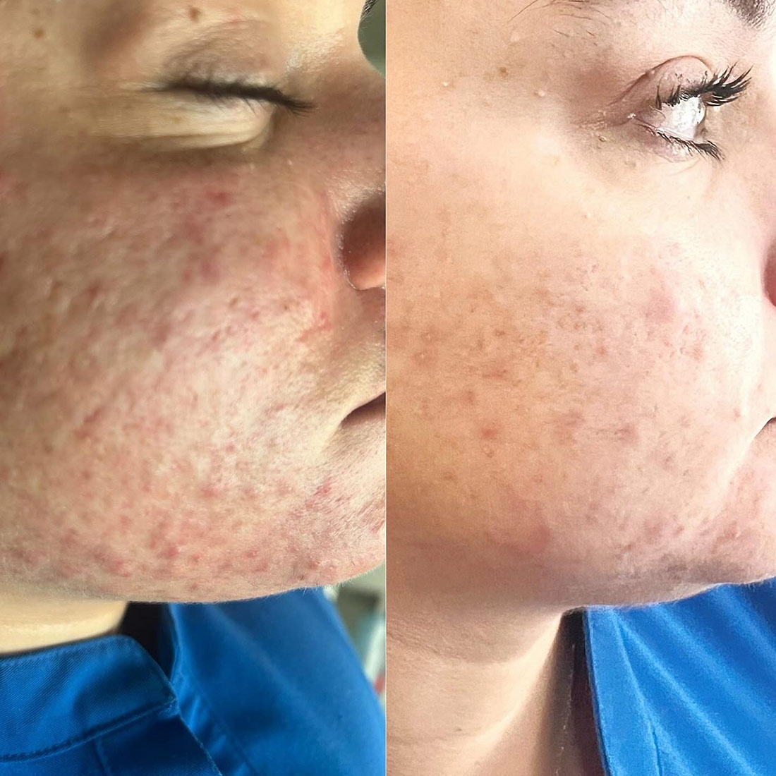 Actual Secret RF Microneedling Patient Before/After