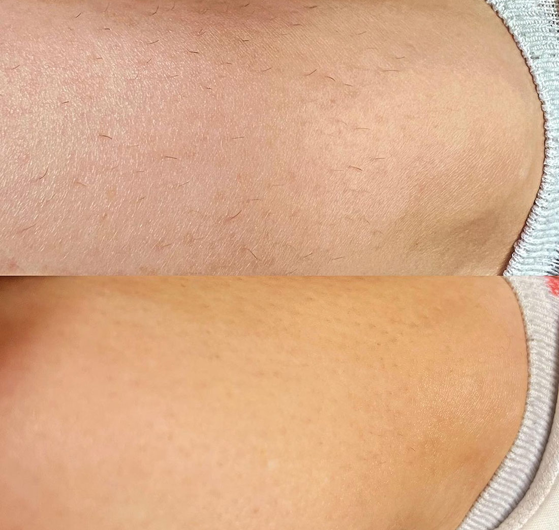 Actual Patient Before/After using Alma Soprano Ice Laser Hair Removal