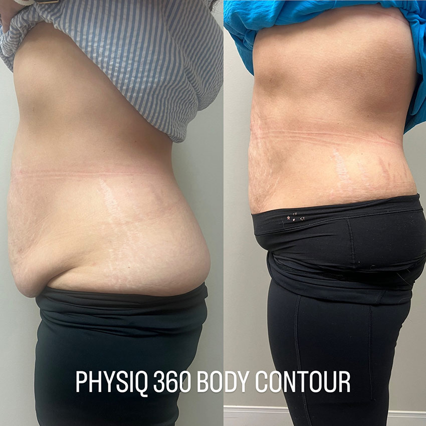 PHYSIQ 360 Before/After