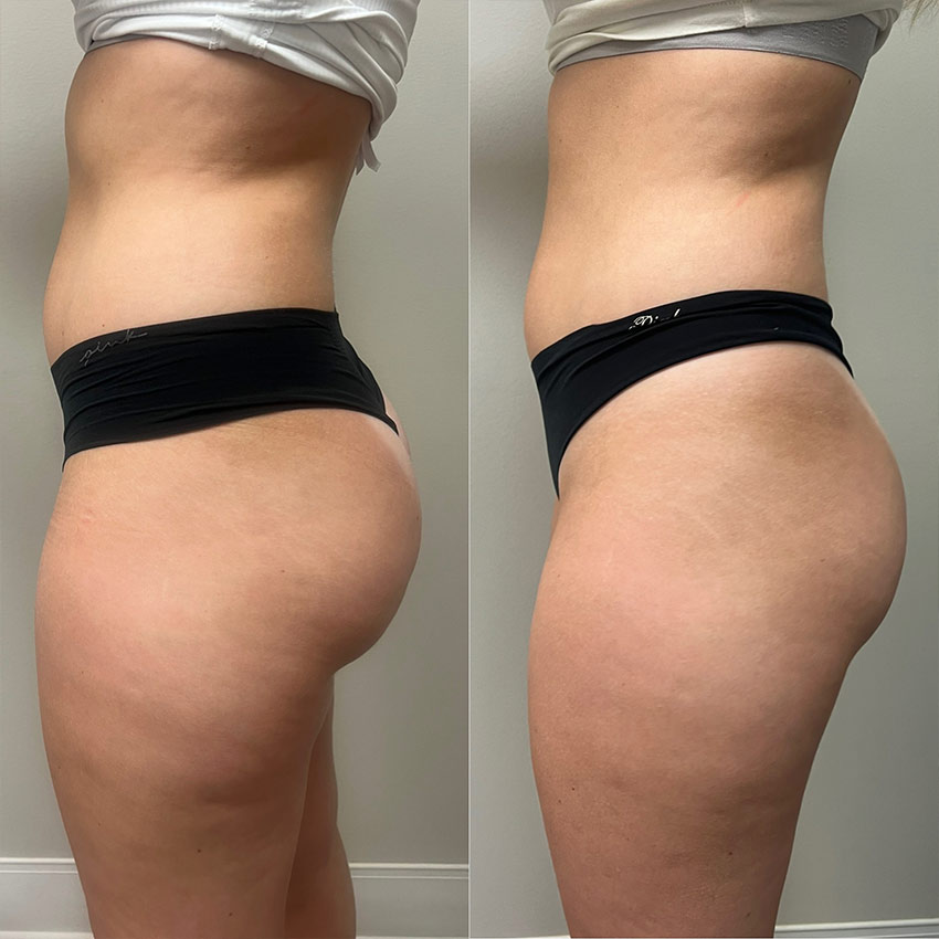 PHYSIQ 360 Before/After