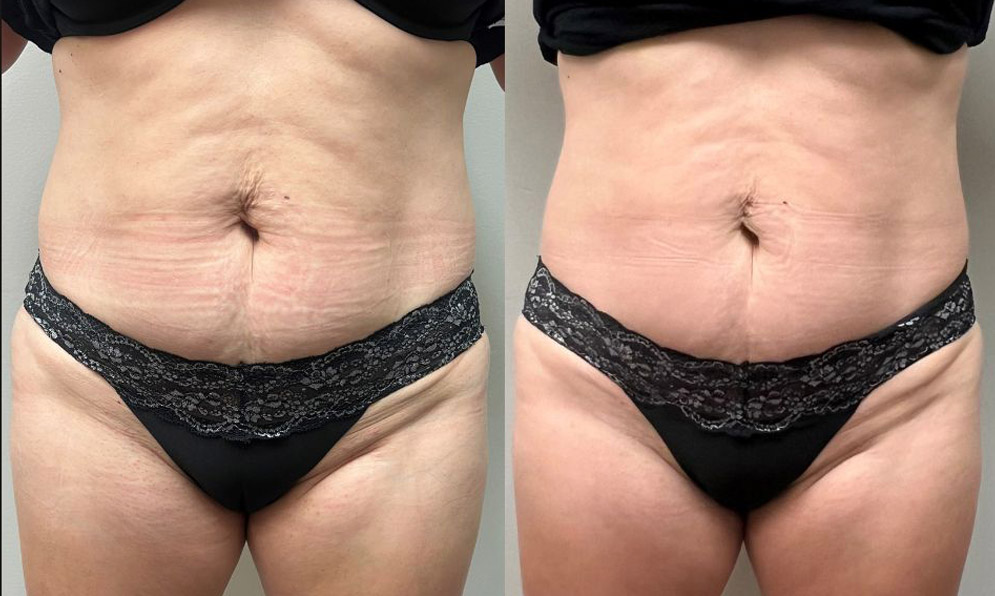 PHYSIQ 360 B&A Template – 2